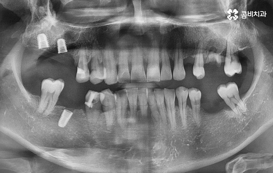 노인임플란트 이때부터 특히 조심하세요 관련 이미지 8