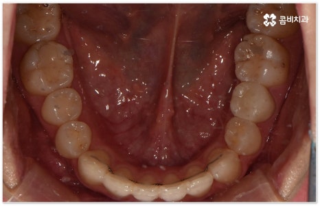 치아교정장치 어떻게 고르나요 관련 이미지 18