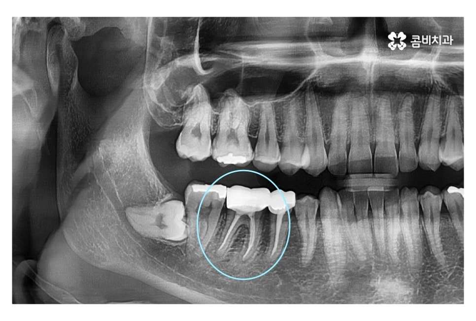 신경치료 후 크라운 시기를 놓치지 않으려면 관련 이미지 6