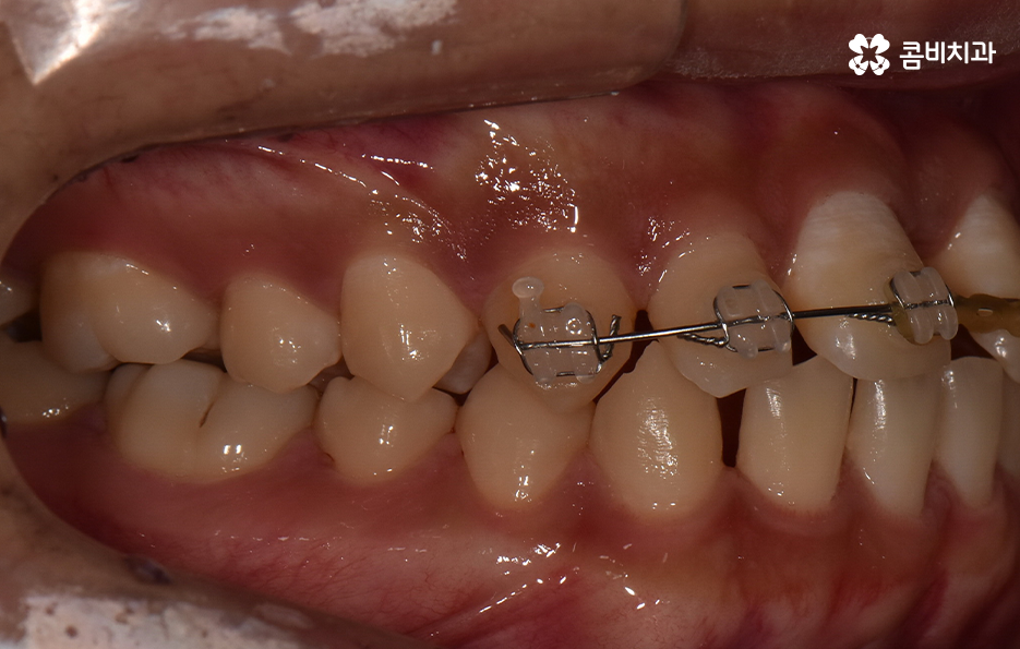앞니만 교정 과잉치 뽑아서 해결했어요 관련 이미지 9
