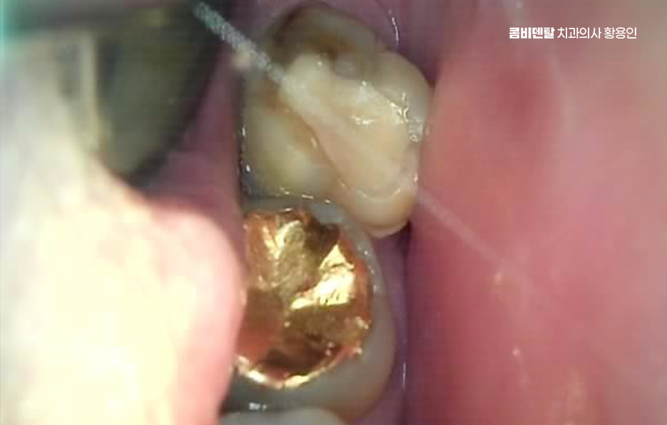 인레이 치료 후 신경치료 이유가 궁금하다면 관련 이미지 6