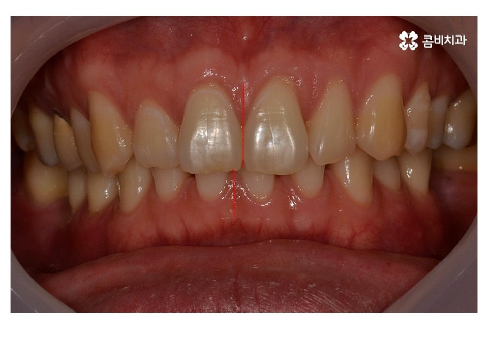 20대임플란트 잦아지는 이유를 알아본다면 관련 이미지 3