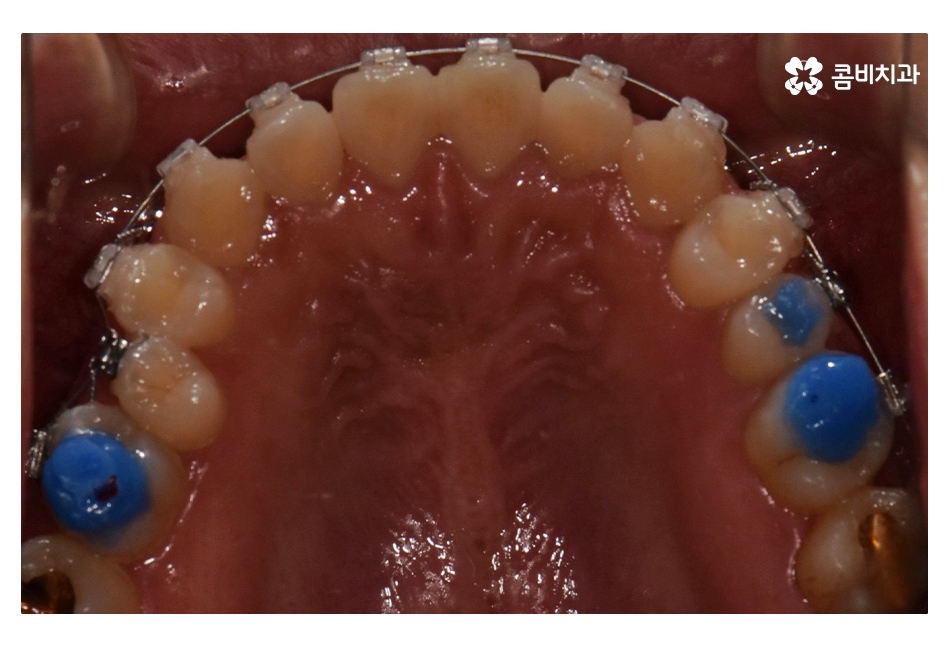 클리피씨교정 늦지않게 결정하려면 관련 이미지 9
