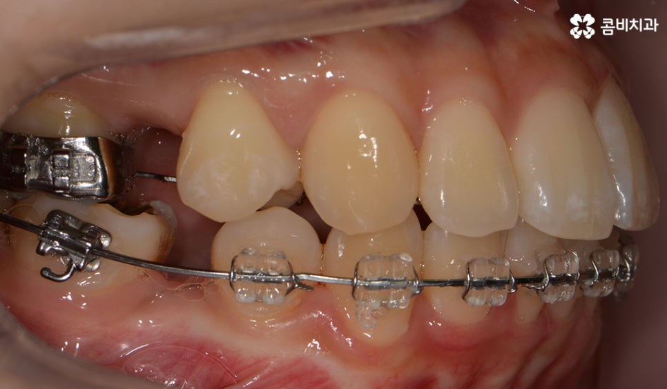 콤비교정 나에게 적합한지 판단하려면 관련 이미지 8