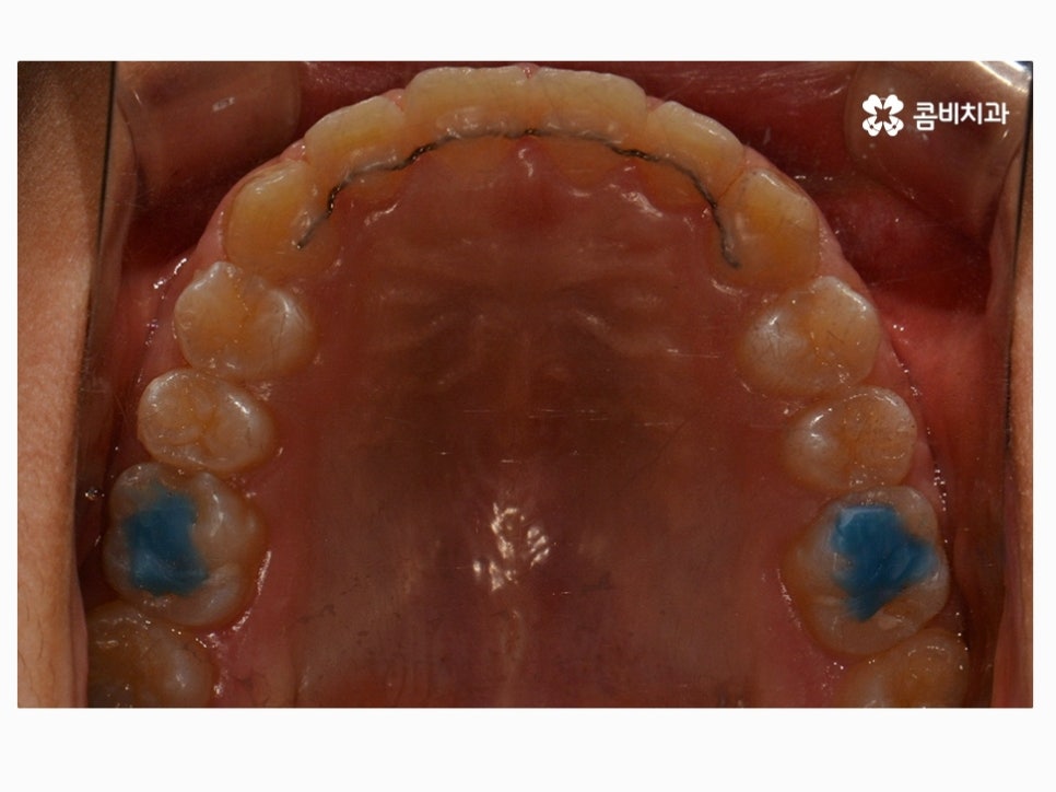 과개교합교정 어릴때 고쳐주면 좋은 사례 관련 이미지 15