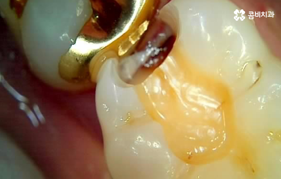 치아 사이 충치 까다로운 이유부터 알아보시죠 관련 이미지 10