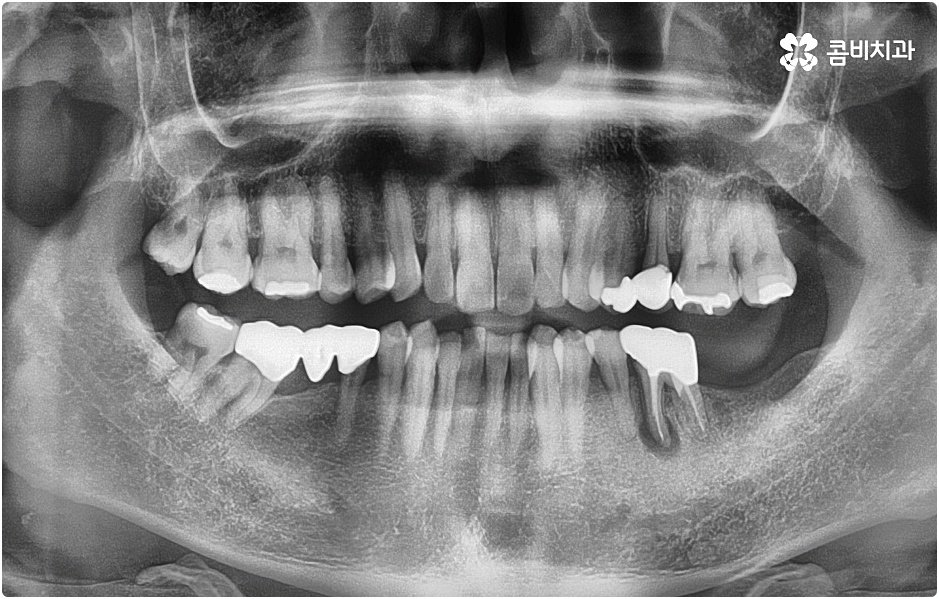 20대임플란트 남의일이 아니라면 관련 이미지 1