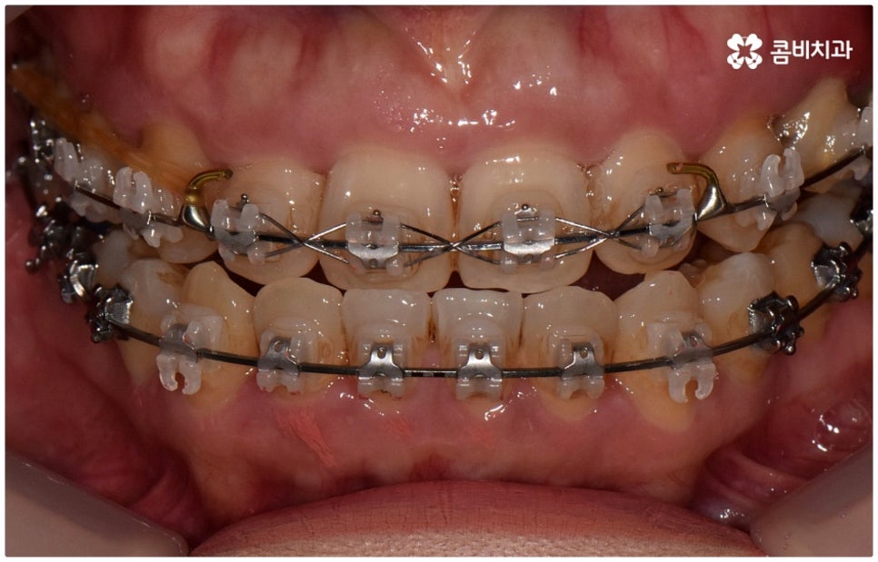 반대교합교정 늦지 않았어요 관련 이미지 9