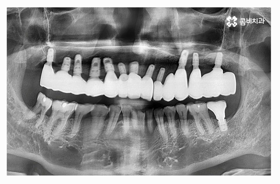 전체임플란트 신중하게 결정하려면 관련 이미지 11