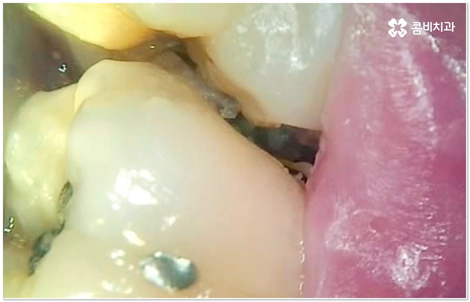 치아 사이 충치 어떻게 하나요 관련 이미지 1