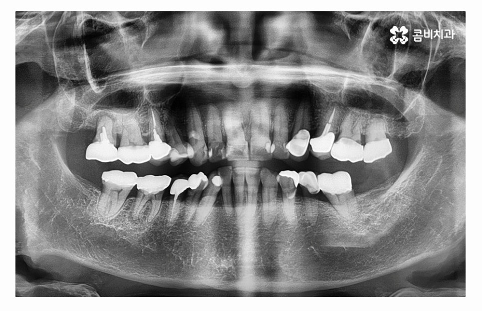 임플란트수술 제대로 알고 선택하려면 관련 이미지 1