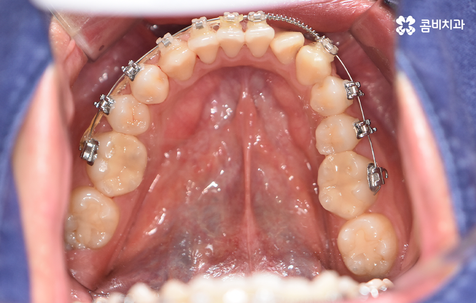 30대 치아교정 빨리 끝내고 싶어요 관련 이미지 12