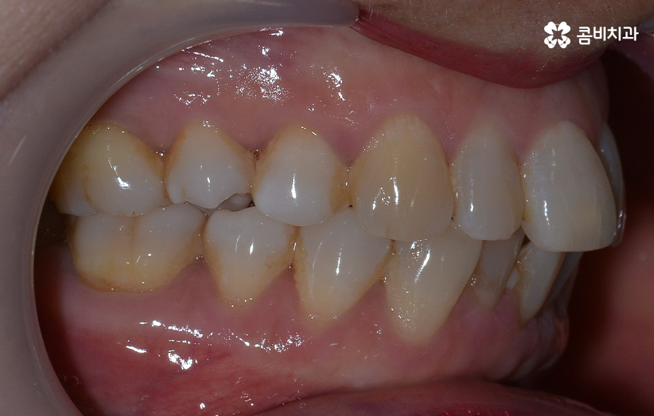 돌출입 콤비교정으로 얼굴까지 개선하는 방법은 관련 이미지 3