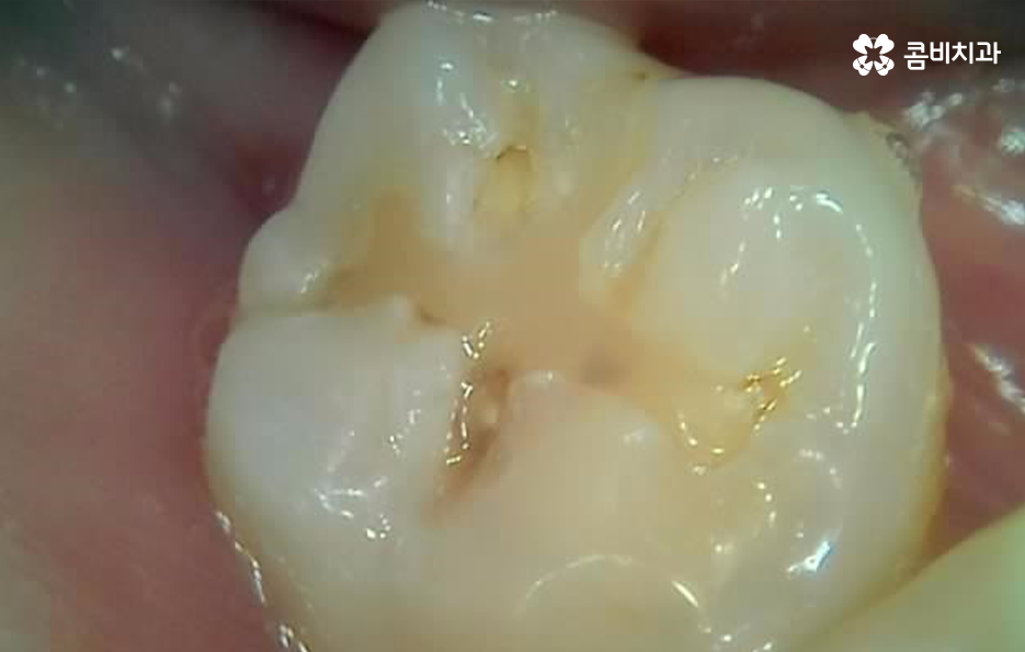 어금니 레진 깨짐 변색 안아파도 이렇게 대처하세요 관련 이미지 2