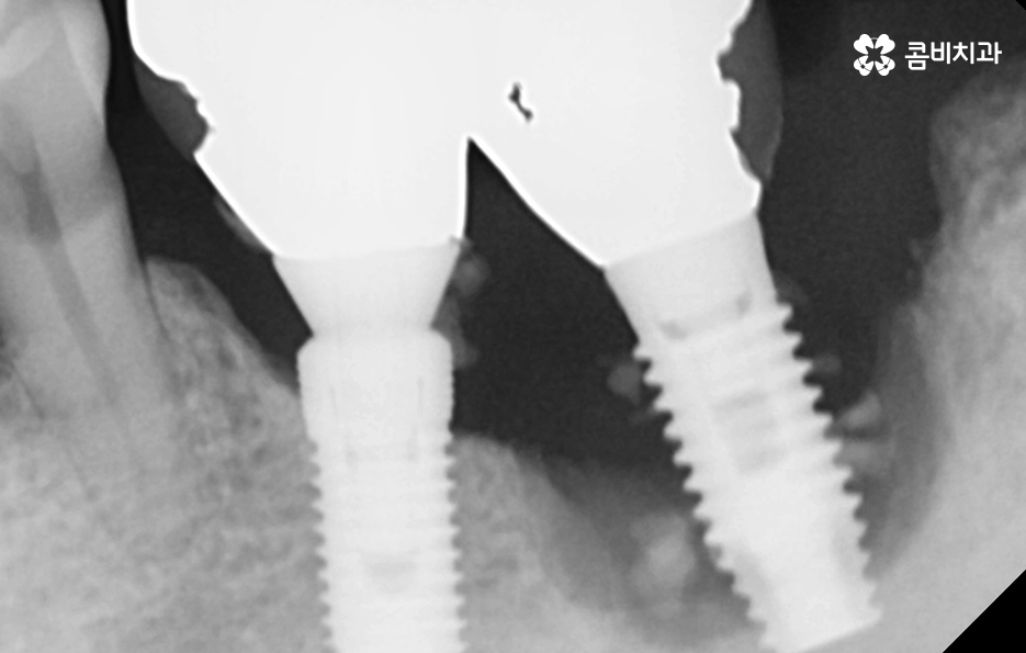 노인임플란트 이것만큼은 기억하세요 관련 이미지 4