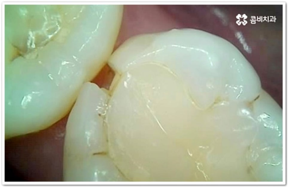 인접면 충치 어떻게 하나요 관련 이미지 8