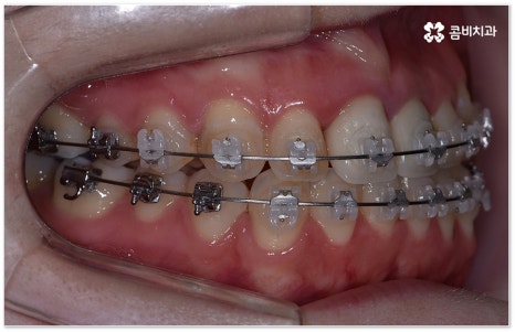 치아교정장치 어떻게 고르나요 관련 이미지 10