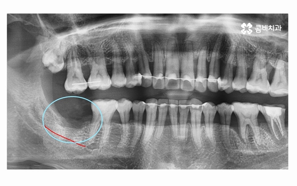어금니 발치 심각해지기 전에 막으려면 관련 이미지 9