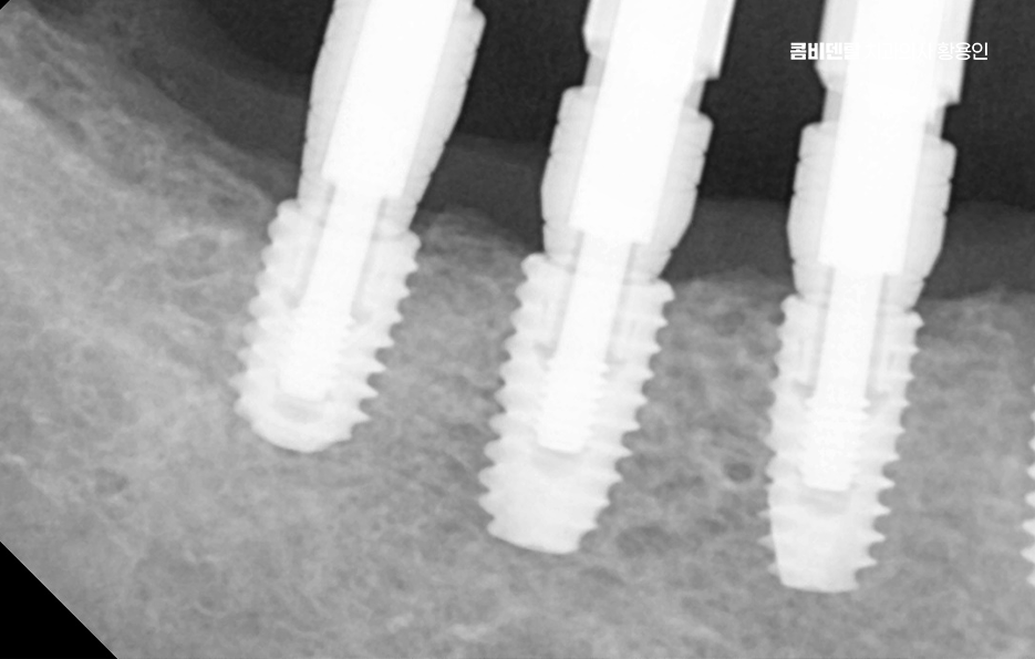 임플란트 뼈이식 안하면 어떤 문제가 있는거죠 관련 이미지 7