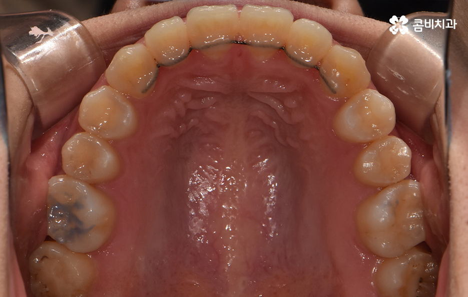 덧니 발치 교정 이런 경우에는 필요합니다 관련 이미지 15