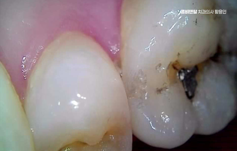 치아 시림 통증 갈수록 심해지다면 관련 이미지 10