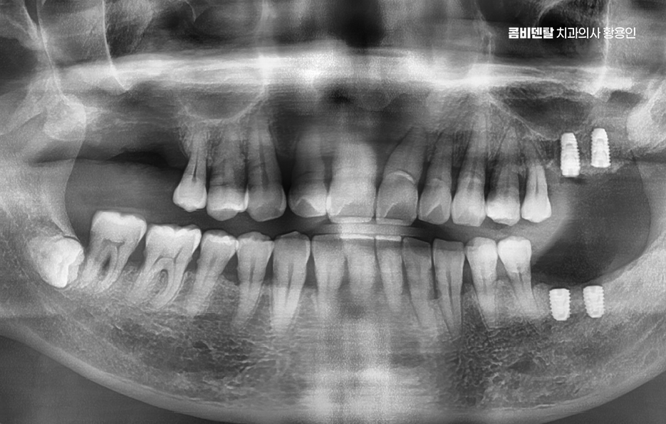 어르신 임플란트 지원 현명하게 활용하려면 관련 이미지 6