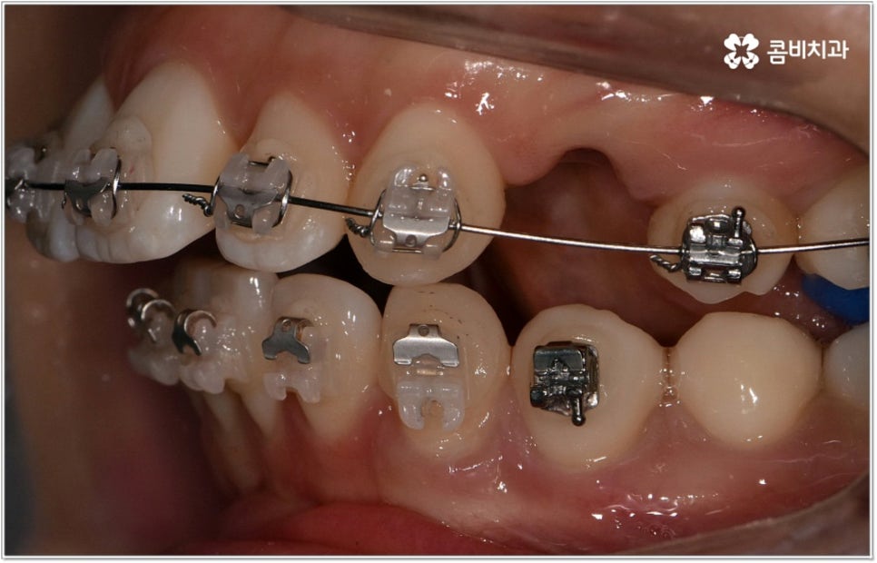 돌출입치아교정 언제가 적기인가요? 관련 이미지 5