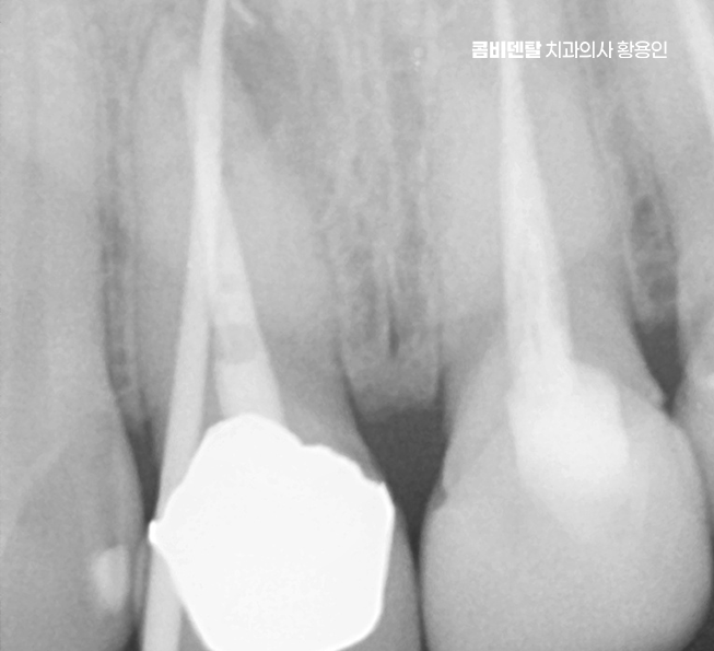 앞니 신경치료 크라운 까지 해야할 상황이라면 관련 이미지 5