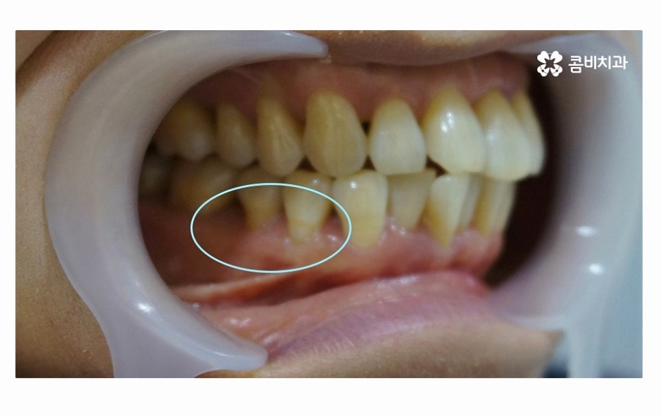 어금니 발치 심각해지기 전에 막으려면 관련 이미지 4