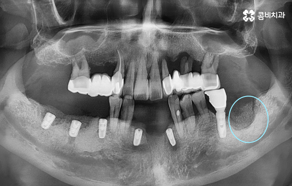 노인임플란트 이것만큼은 기억하세요 관련 이미지 5