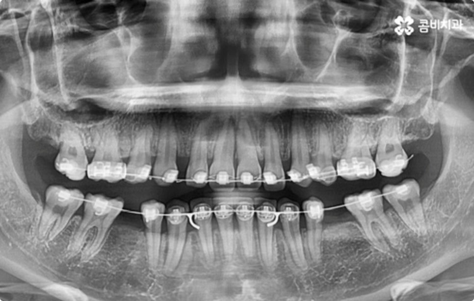 직장인치아교정 어떻게 시작하나요? 관련 이미지 11