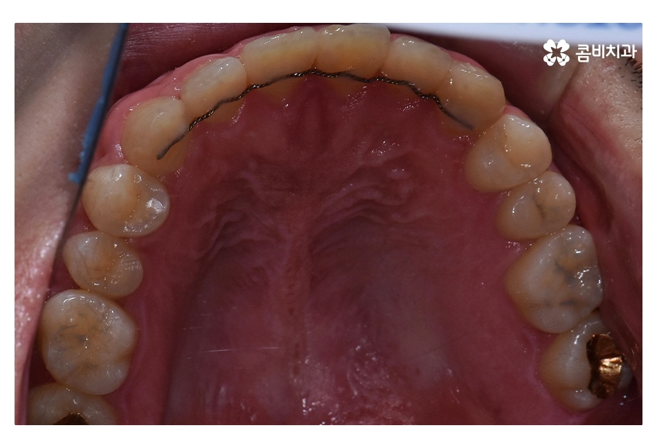 클리피씨교정 늦지않게 결정하려면 관련 이미지 16