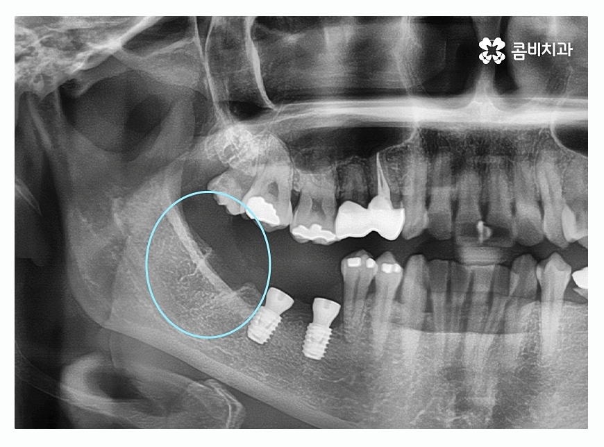 임플란트종류 잘알아보고 적용하려면 관련 이미지 5