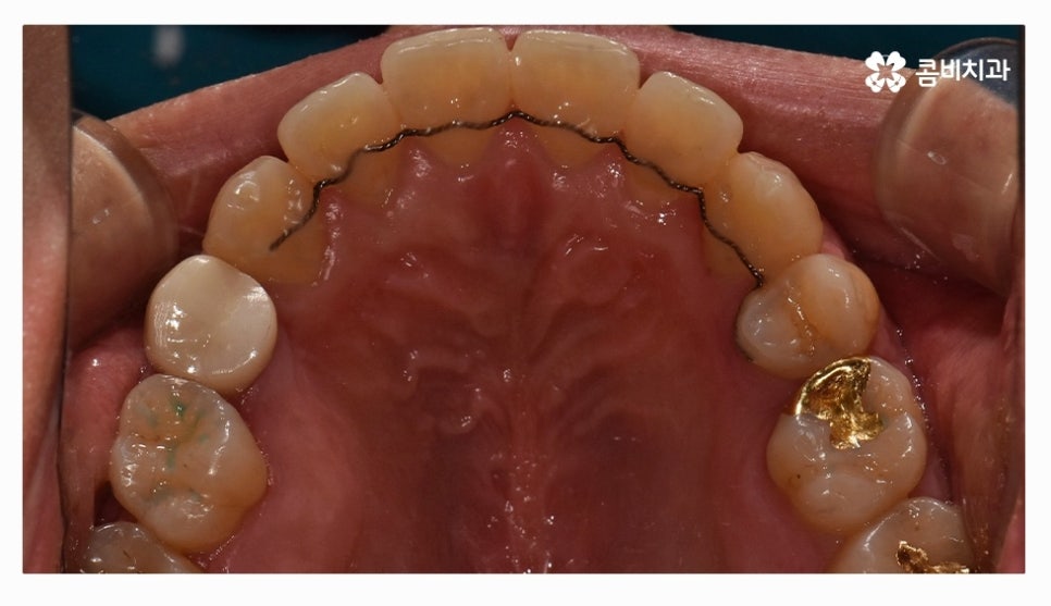 클리피씨교정 올바르게 판단하려면 관련 이미지 15