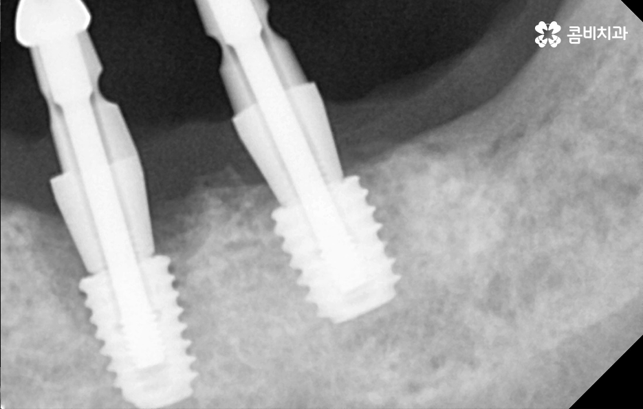 건강보험 임플란트 적용 받기 전에 알아두세요 관련 이미지 5