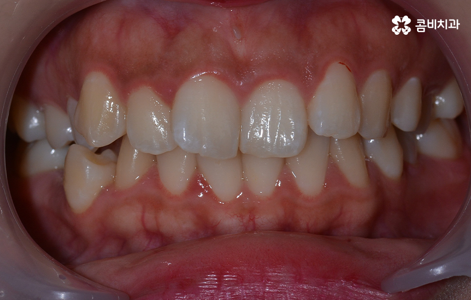 덧니 발치 교정 이런 경우에는 필요합니다 관련 이미지 2