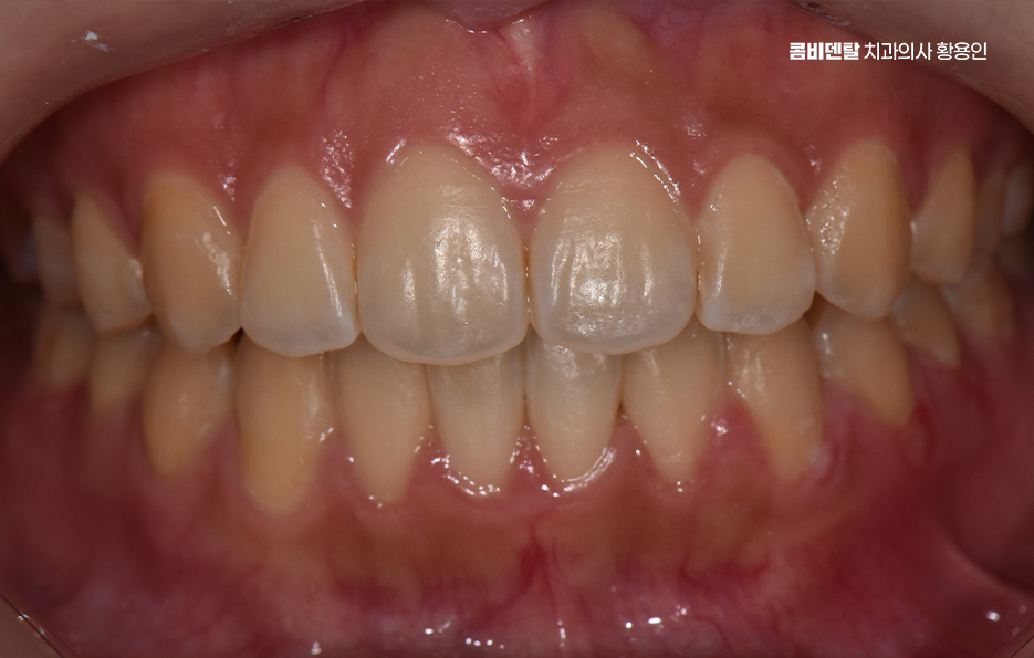 How Can You Determine the Duration of Front Teeth Orthodontic Treatment? image 11