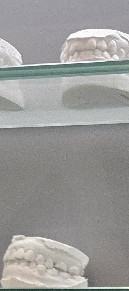 앞이빨 임플란트 과정 주의해야할 포인트는 관련 이미지 12