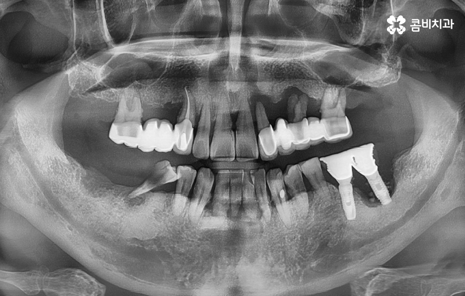노인임플란트 이것만큼은 기억하세요 관련 이미지 1