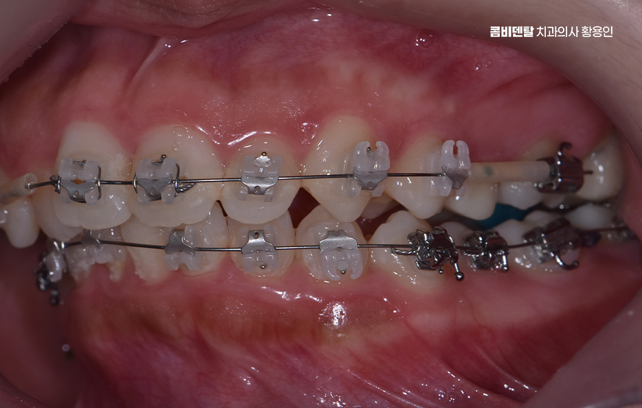 비발치 돌출입 교정 어떨때 적절할까 관련 이미지 7
