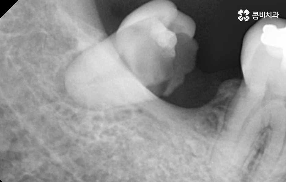 임플란트 치료기간 어느정도 걸리고 치과에는 몇번 가나요 관련 이미지 3