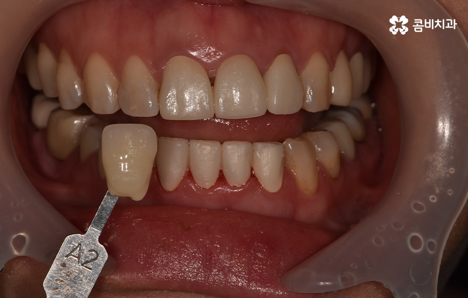 아래 앞니깨짐 치료 감쪽같이 해결하려면 관련 이미지 7