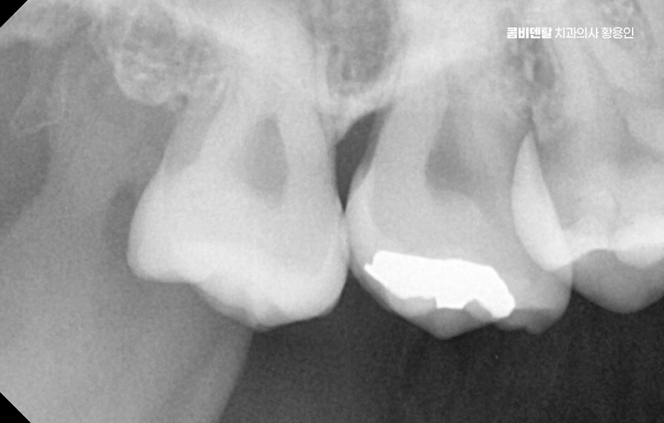 How to Systematically Prepare for Wisdom Tooth Extraction Due to Cavities image 6