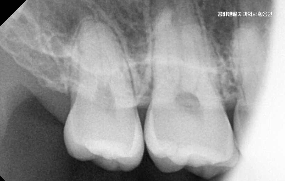 완전매복사랑니 발치 대학병원 꼭 가야하나요 관련 이미지 4