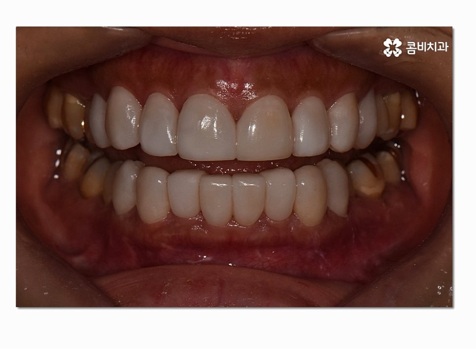 치아라미네이트 누구에게 필요할지 궁금하다면 관련 이미지 4