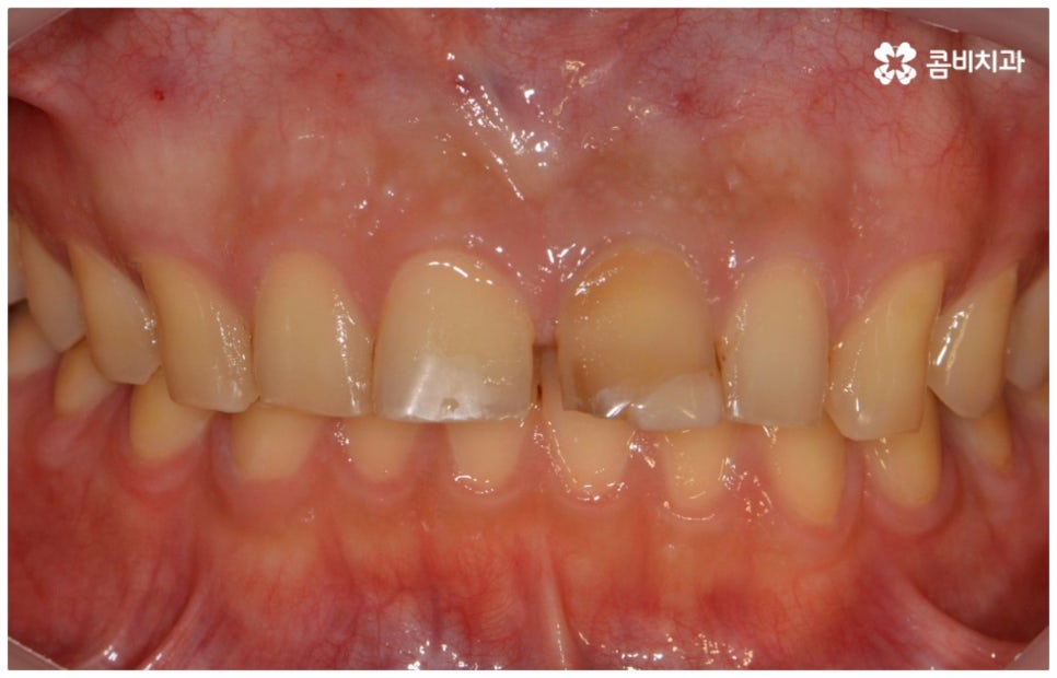 앞니충치치료 어떻게 이뤄지나요 관련 이미지 1