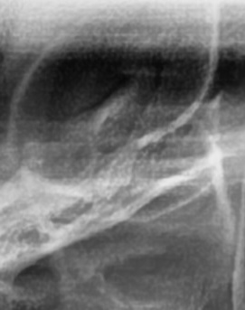 어금니 뒤 잇몸 부음 어떤 문제길래 이런거죠 관련 이미지 9