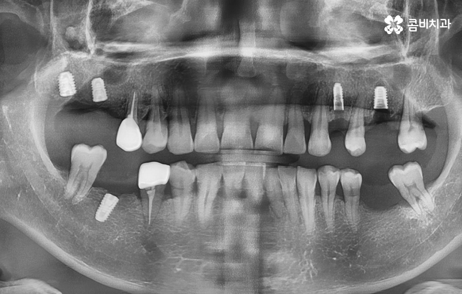 노인임플란트 이때부터 특히 조심하세요 관련 이미지 9