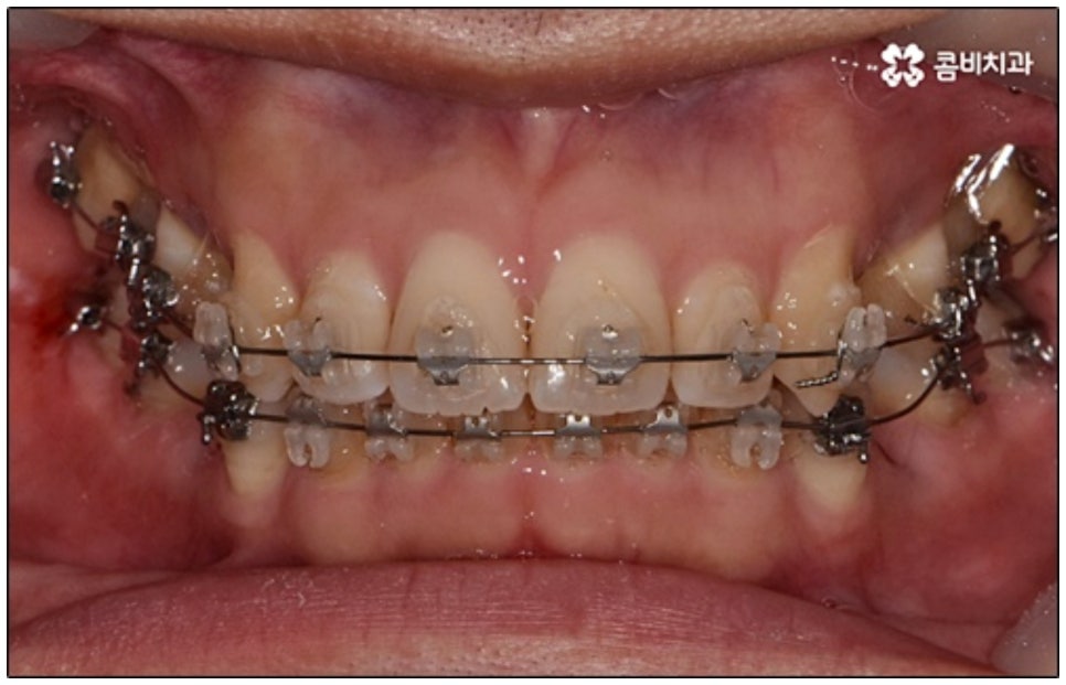 클리피씨교정 알아봐야 할것들 관련 이미지 3