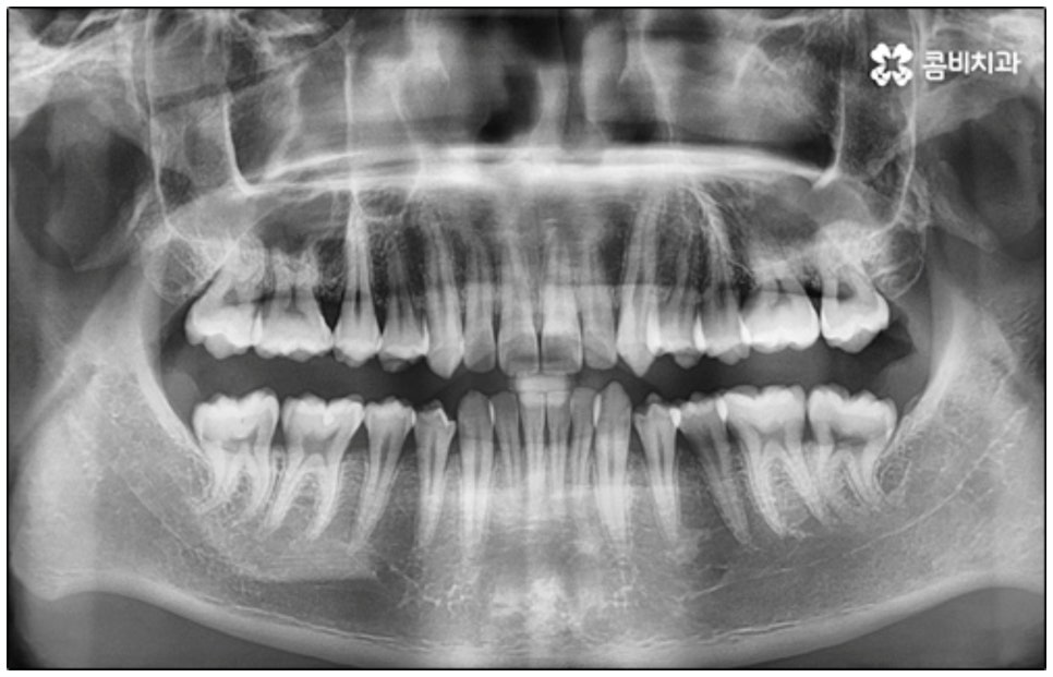 클리피씨교정 알아봐야 할것들 관련 이미지 2